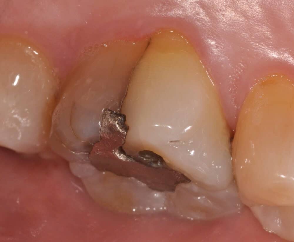 Molar with Crack