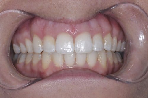 Invisalign after