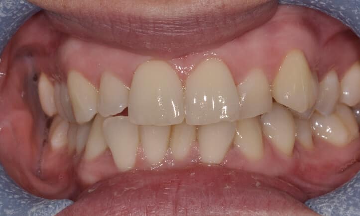 Teeth Whitening Peninsula